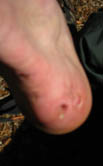 June 2010 wound