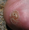 wound