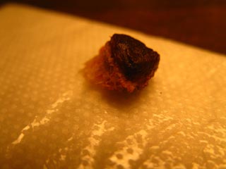 Bone Fragment from frostbite