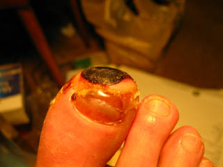 Frostbite: Early necrosis and first separation of live and dead skin.