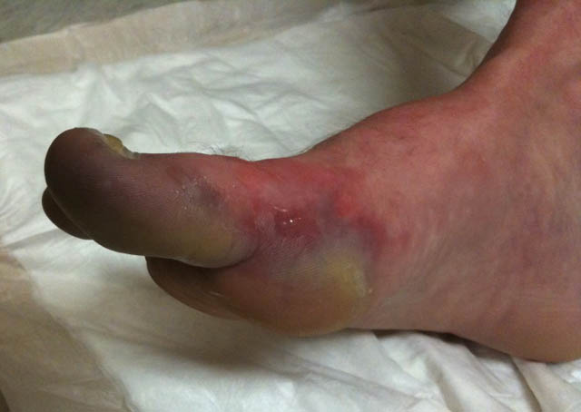 Frostbit foot, side view
