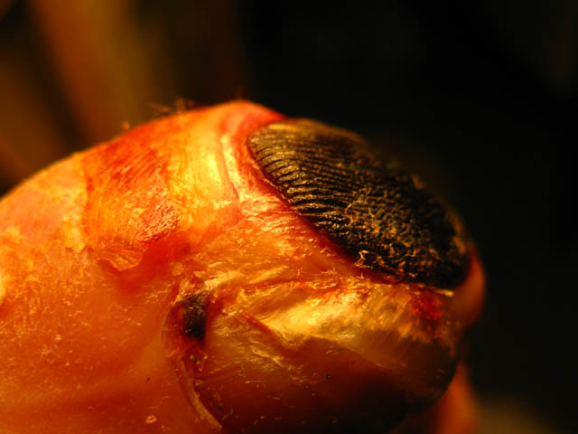 Dead skin at the tip of my Right big toe from frostbite