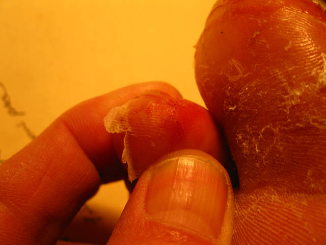 The skin is going to come off the tip of the second toe