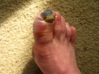 Blistering and dying skin on frostbite foot.